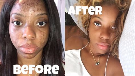 African Black Soap Before and After Results