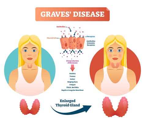 Graves' Disease