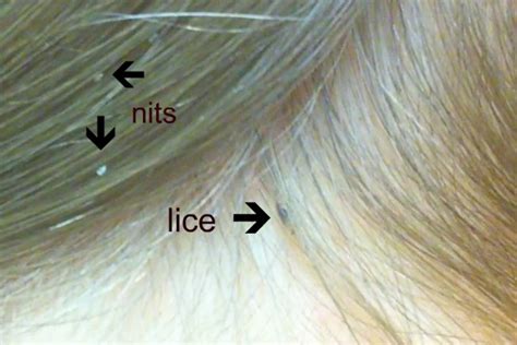 Lice and Nits in Hair
